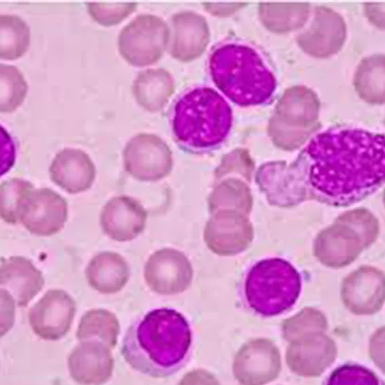 chronic lymphocytic leukaemia cll prognostic panel test